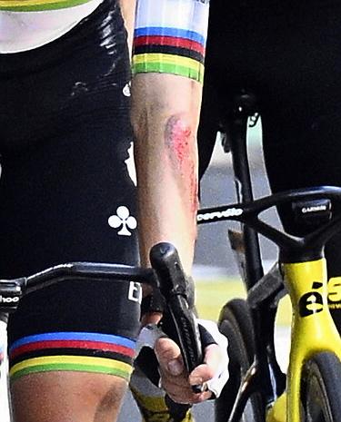 The injured arm of Slovenian Tadej Pogacar of UAE Team Emirates pictured at the finish of stage 11 of the 2025 Tour de France cycling, from and to Toulouse (154km), on Wednesday 16 July 2025 in France. The 112th edition of the Tour de France starts on Saturday 5 July in Lille, France, and will finish in Paris, France on the 27th of July.   BELGA PHOTO JASPER JACOBS